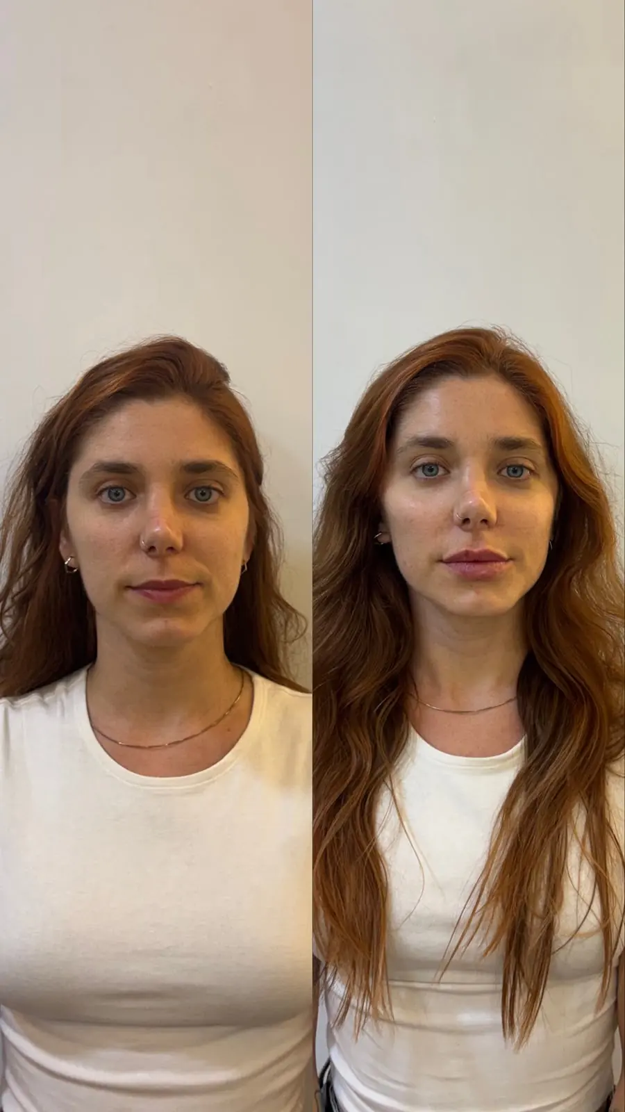 Resultado 5: foto de antes e depois do tratamento de uma paciente