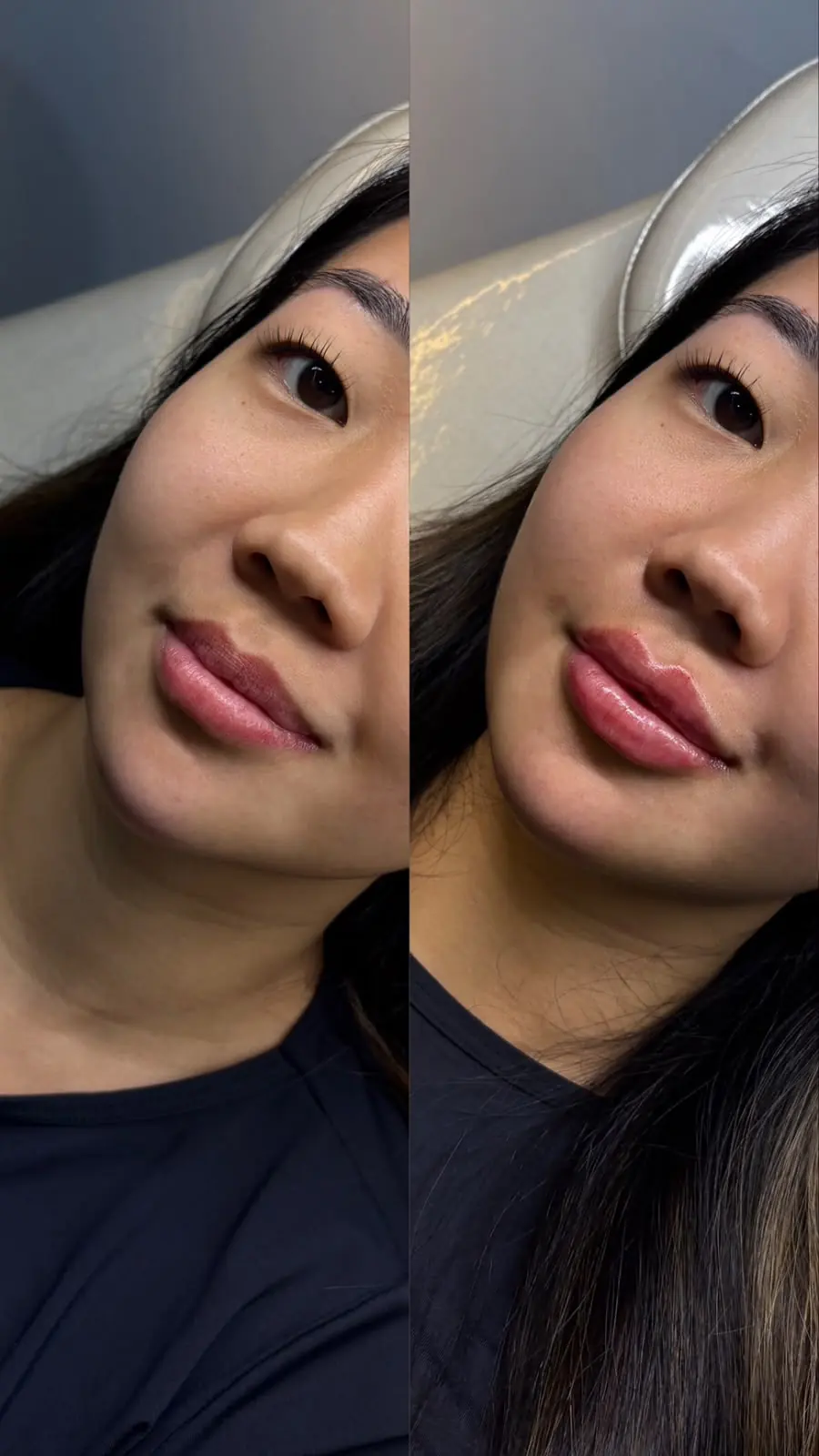Resultado 3: foto de antes e depois do tratamento de uma paciente