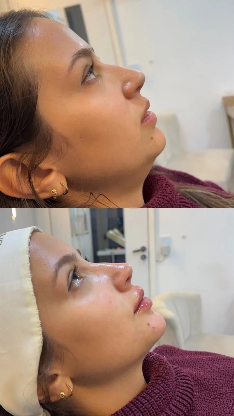 Resultado 1: foto de antes e depois do tratamento de uma paciente